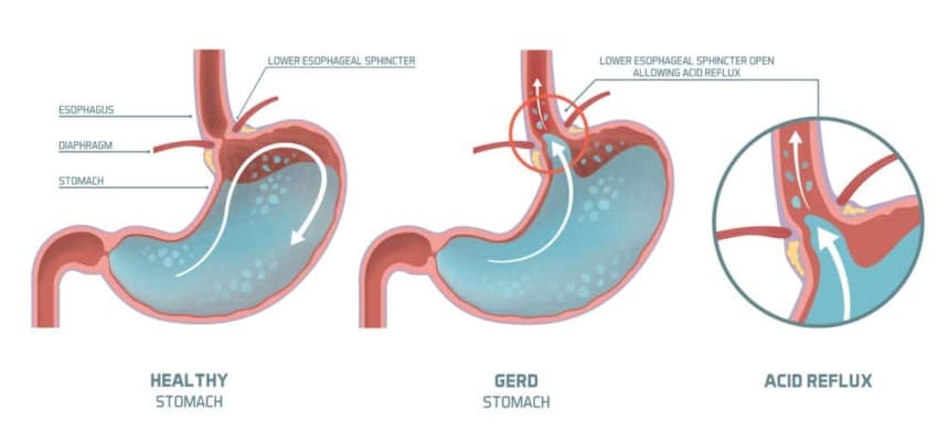 Does Sleeping in Recliner Help Acid Reflux?